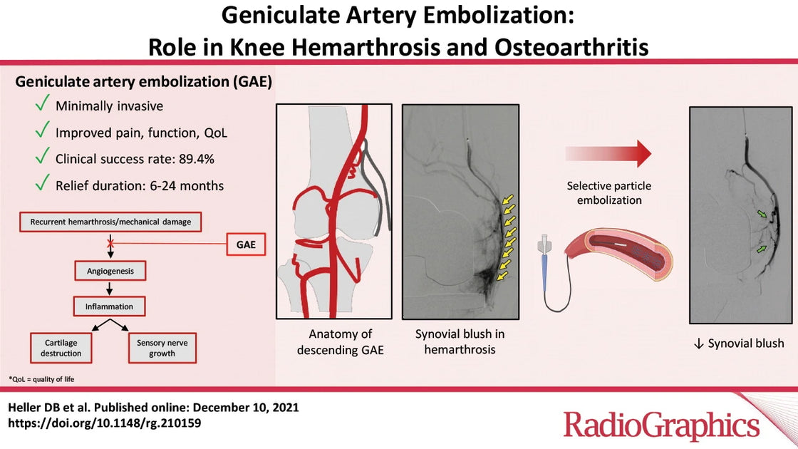 U R Gae Geniculate Artery Embolization for Knee Pain Relief | LAIIC – LA ...