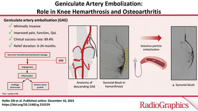 Geniculate Artery Embolization for Knee Pain Relief