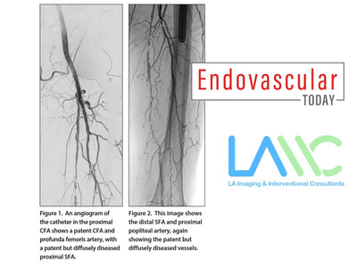 Peripheral Artery Disease Case: LAIIC in Endovascular Today