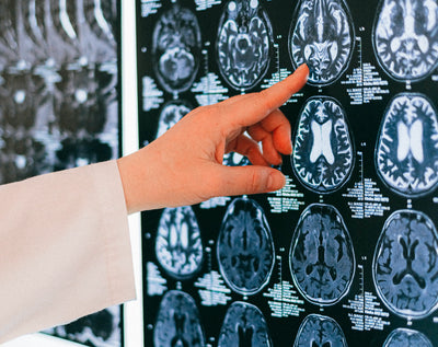 A Quick Guide to Subdural Hemorrhages